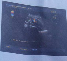 42岁囊肿积液做泰国试管婴儿成功怀孕