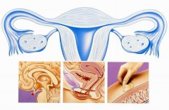 做试管婴儿会影响到卵巢功能吗？试管婴儿取卵后该怎么调理卵巢？