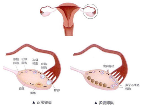 多囊卵巢可以做试管吗？多囊卵巢做试管婴儿如何提高成功率？